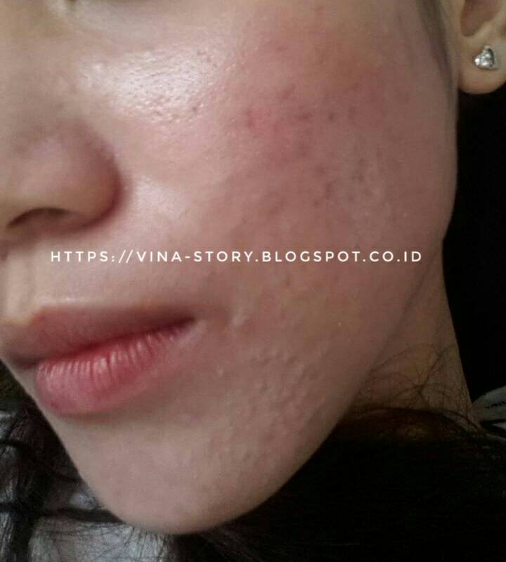 Mommies Beauties Journal Pengalaman Lepas Krim Dokter Atau Perawatan Di Dokter Spkk Breakout Trial Error Purging Acne Fight Survive Part 1