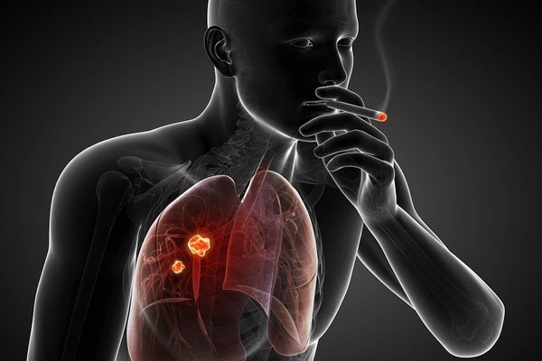 التدخين يسبب سرطان الرئه