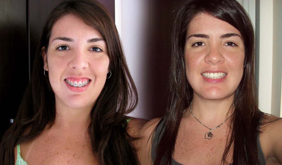 Cirurgia Ortognática ANTES e DEPOIS Cirurgia Ortognática ANTES e DEPOIS