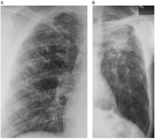 Radiologi paru-paru penderita coal worker pneumoconiosis Radiologi paru-paru penderita coal worker pneumoconiosis