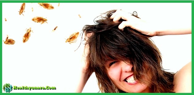 Find out the causes and symptoms of head lice Find out the causes and symptoms of head lice