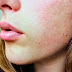 5 Komposisi skincare yang harus dihindari jika kamu memiliki Eczema