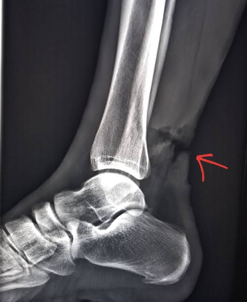 HOW TO TREAT TORN ACHILLES TENDON