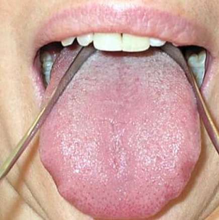 Why Tongue Cleaning