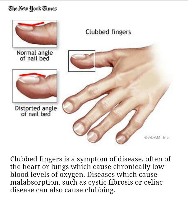 Top 100+ Pictures What Does Clubbing Of The Fingers Look Like Updated