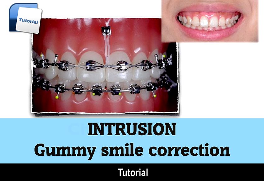 INTRUSION Gummy smile correction Chris Chang