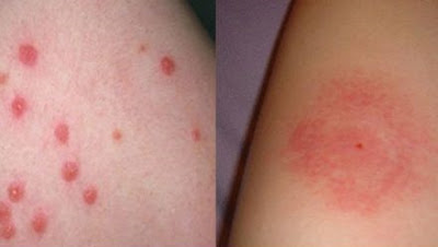 Bed bug bites vs Mosquito bites Pictures, Size, Identification