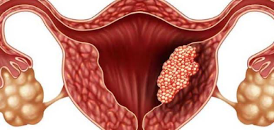 أسباب تقرحات الرحم وكيفية الوقاية منها
