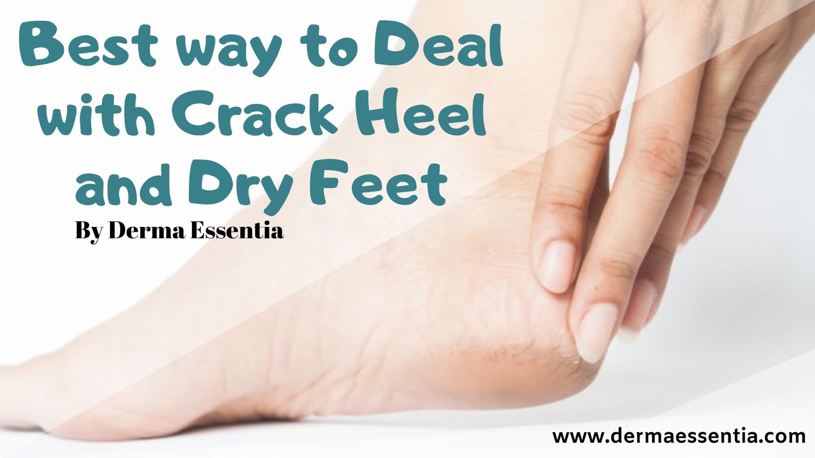 Which is the Best Foot Cream for Dry Cracked Feet?