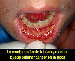 cáncer de boca