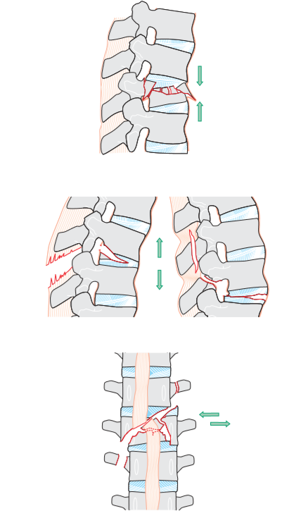 11:50: Inestabilidad de la Columna Vertebral