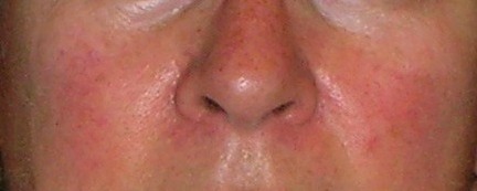 rosacea