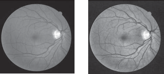 Montagen retinal platina. Атрофия зрительного нерва лебера. Ретиношизис дистрофия сетчатки. Montagen retinal platina. Montagen retinal platina.