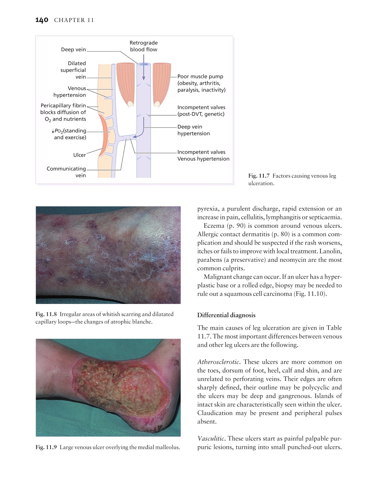 Ehlers danlos syndrome type marfanoid bruising periodontitis scars fig scar paper atrophic cigarette facies viii distinctive habitus easy Medicine by Sfakianakis G. Alexandros: Skin disease in perspective 4