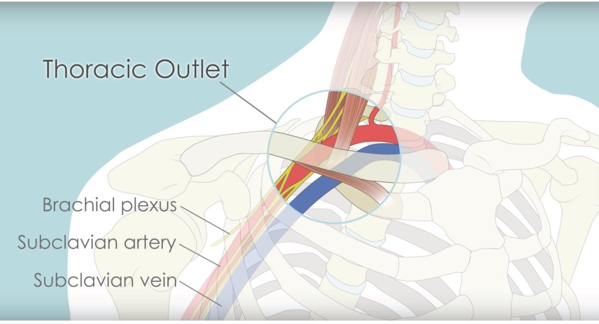Massage La Mesa THORACIC OUTLET SYNDROME AND MASSAGE