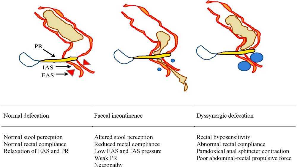 overflow incontinence neurogenic overflow incontinence neurogenic