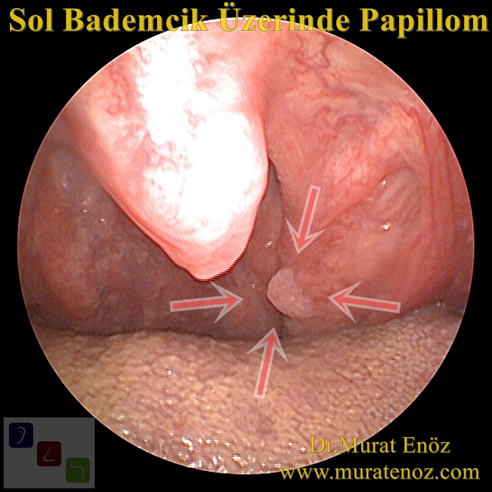 pikkelyes papilloma mindig hpv