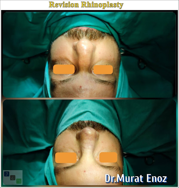 Revision Nose Aesthetic Operation in Istanbul,