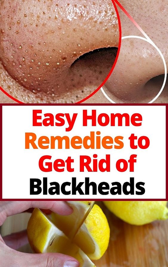Easy Home Remedies to Get Rid of Blackheads medicine health life