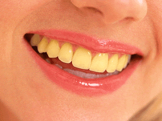 Cara Mudah Mencegah Gigi Putih Jadi Kuning