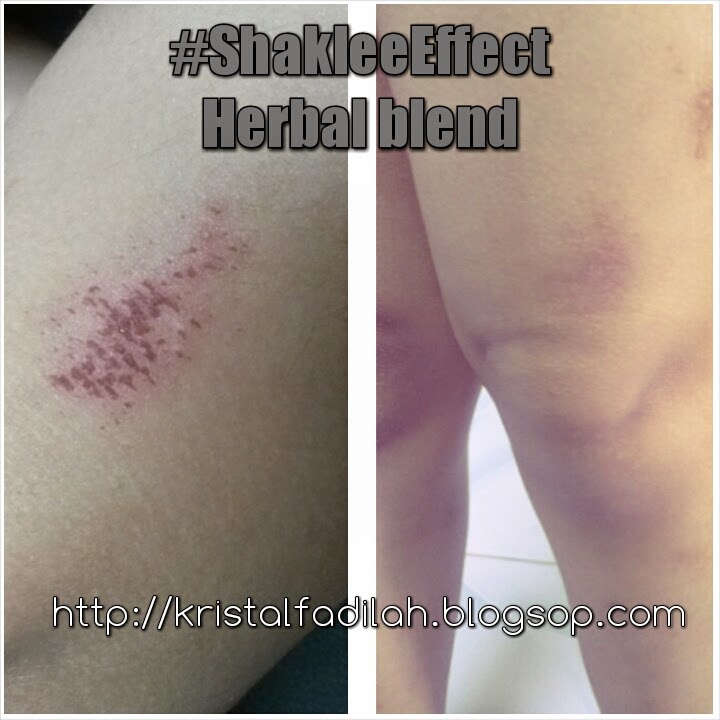 Cara Hilangkan Parut Eczema Kumpulan Cara Terbaru 2022