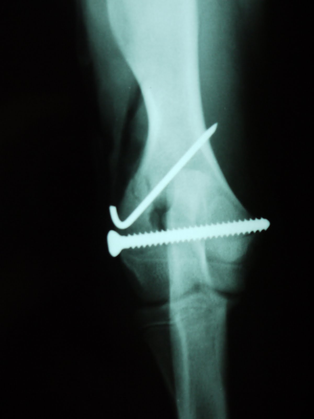 Traumatologia y Cirugia Ortopedica Veterinaria: FRACTURA CONDILO HUMERAL