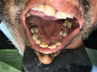 Dental caries in a senior patient before treatment