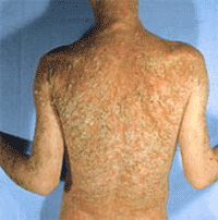 psoriasis care plan)