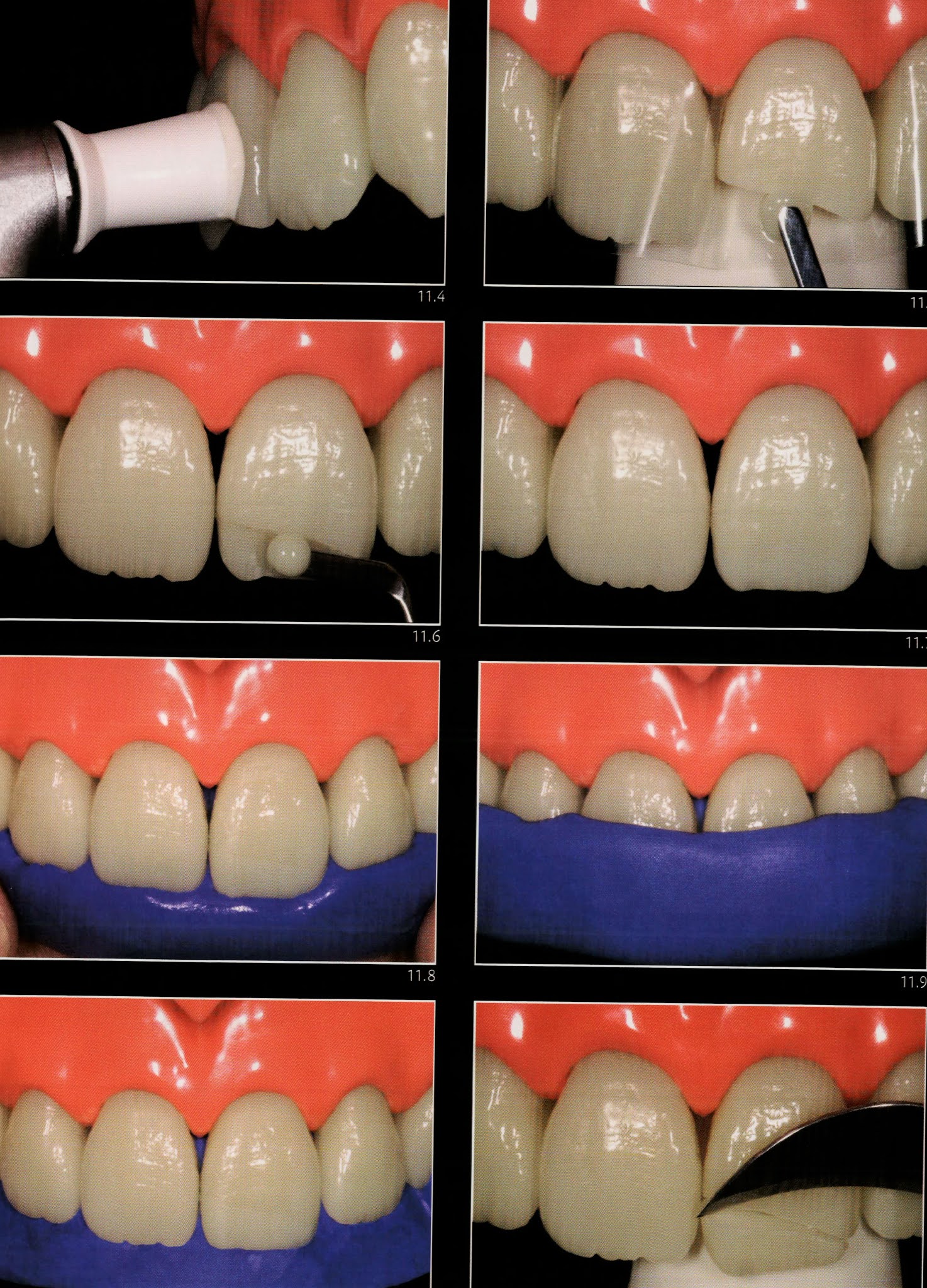 Class IV composite " silicone guide technique " Dental Esthetics