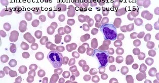 High lymphocytes after covid-19 picture