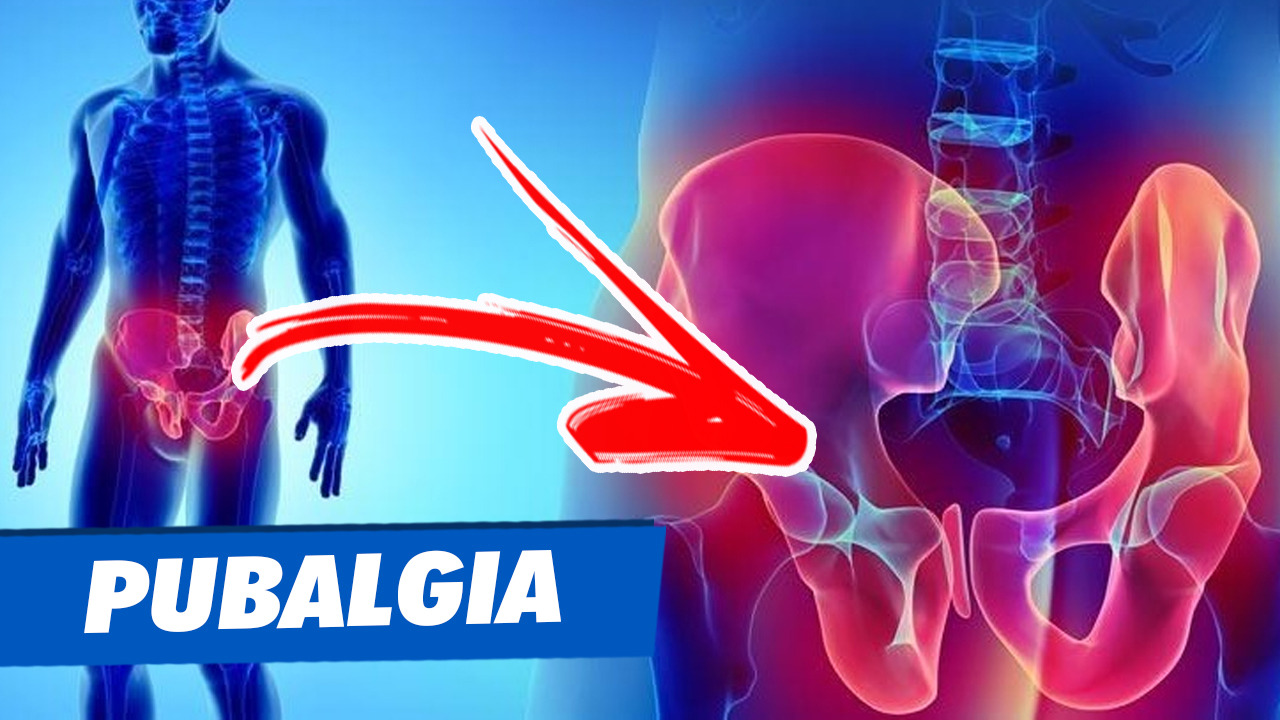 DOR NA VIRILHA, DOR NO PUBIS, pode ser PUBALGIA DOR NA VIRILHA, DOR NO PUBIS, pode ser PUBALGIA