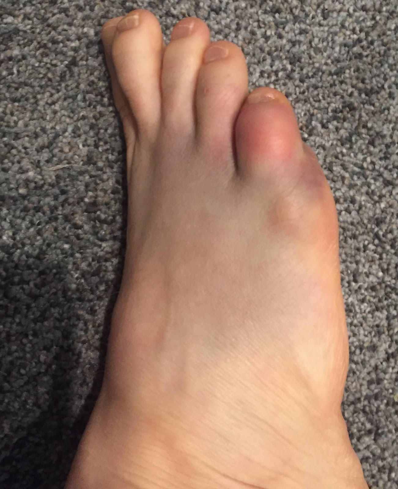 Collection 90+ Images bruise on side of foot no reason Sharp