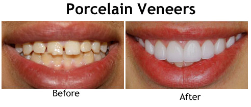 veneers porcelain nyc dental tooth much before dentistry cosmetic dentist dentures professionals common services today most used luten just income