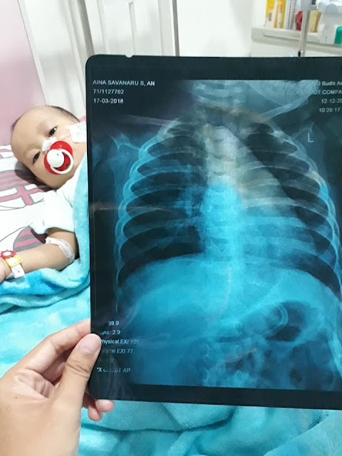 Miris! Karena Asap Rokok Sang Ayah, Bayi Ainaa Derita Penyakit Broncopneumonia Miris! Karena Asap Rokok Sang Ayah, Bayi Ainaa Derita Penyakit Broncopneumonia