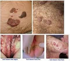 Obat Kutil Kelamin Penyakit Menular Seksual Obat Kutil Kelamin Penyakit Menular Seksual