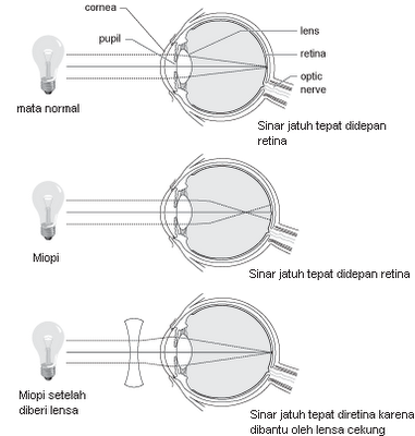Pandangan Buram Ketika Melihat Objek Jarak Jauh? Miopia (Rabun Jauh).