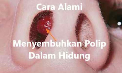 Ini Obat Alami Polip Hidung - Syakir Daulay