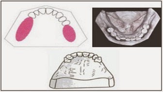 Pemasangan Gigi Tiruan Jembatan dengan Kelainan ...
