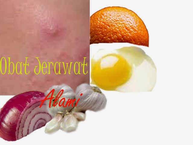 Pengobatan Jerawat Alami dan Irit Biaya