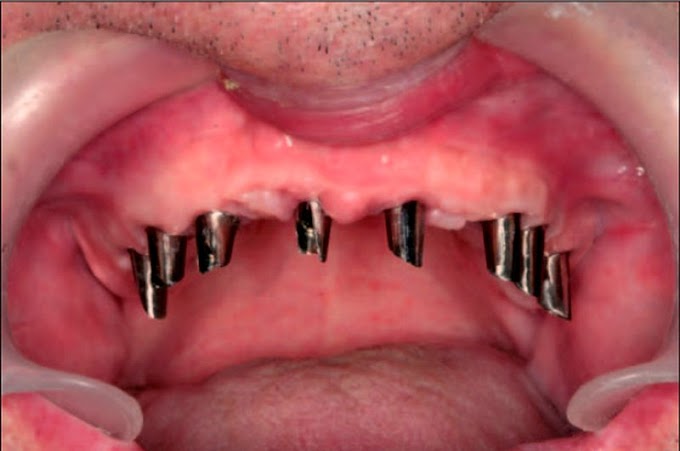 PDF: El tratamiento con implantes dentales en los pacientes adultos mayores