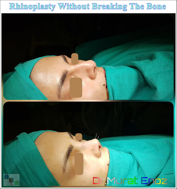 Nose Job Without Toching The Bone in Istanbul,Rhinoplasty without breaking the bone,