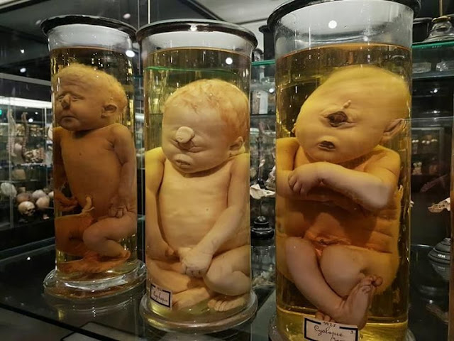 أجنة مشوهة في متحف بالقصر العيني أجنة مشوهة في متحف بالقصر العيني