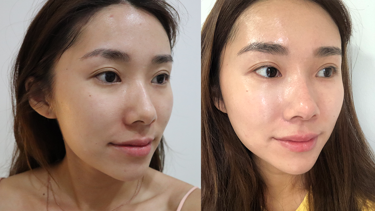 MY EXPERIENCE WITH REJURAN HEALER , ASTIQUE CLINIC, PRICE MONGABONG