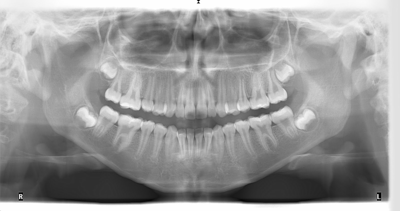 FUNDAMENTOS DE RADIOLOGÍA ORAL Y MAXILOFACIAL RADIOGRAFÍA PANORÁMICA FUNDAMENTOS DE RADIOLOGÍA ORAL Y MAXILOFACIAL RADIOGRAFÍA PANORÁMICA