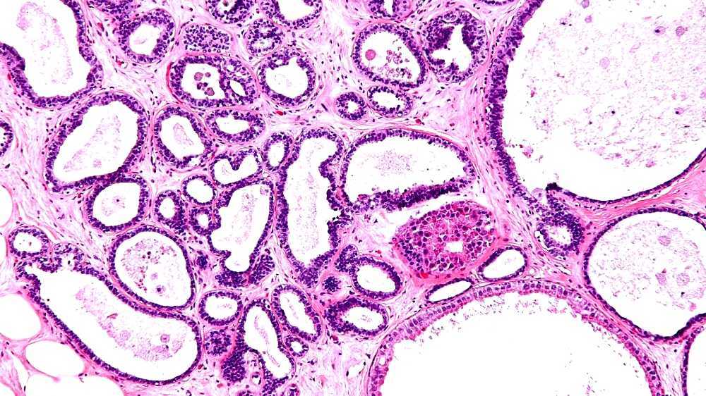 fibrocystic breast changes brown dishcharg fibrocystic breast changes brown dishcharg