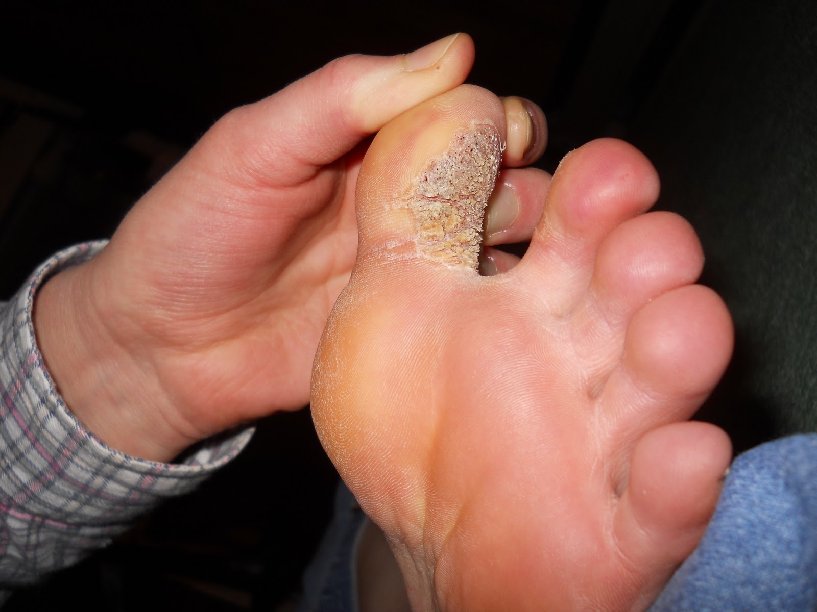 Plantar warts on sole of foot, wart on my toe, dr scholl