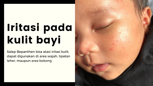 review salep ruam popok, salep popok bayi, salep ruam popok, salep untuk bayi, review bepanthen, bepanthen, bepanthen salep ruam popok, harga salep bepanthen, beli bepanthen, ruam popok, cara mencegah ruam popok