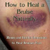 Heal Bruises And Black Eyes More Faster With These Natural Remedies