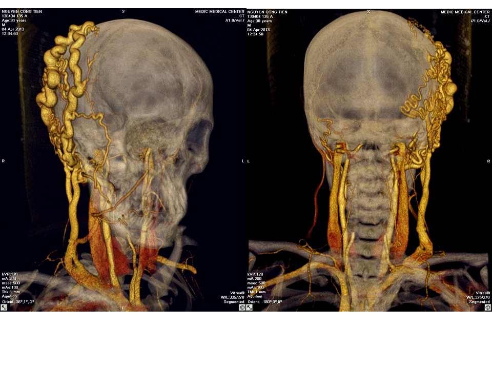 VIETNAMESE MEDIC ULTRASOUND CASE 180 AV FISTULA POST OP MIDDLE EAR