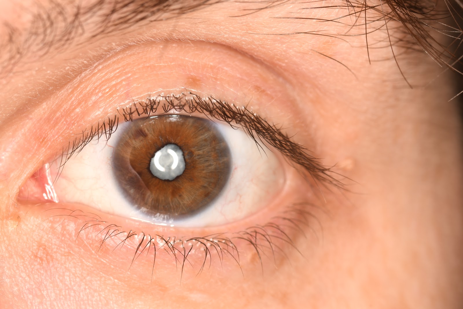 the-story-of-my-eye-before-cataract-surgery-photos